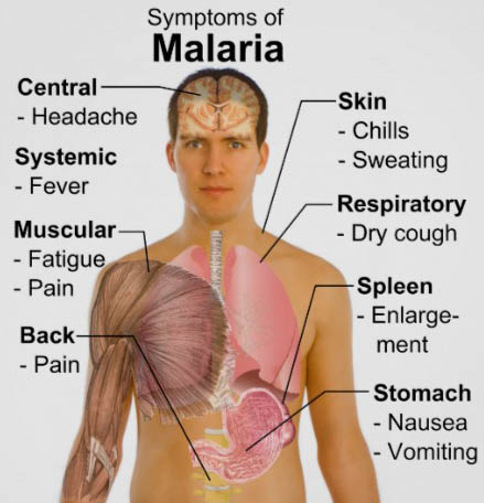 sintomi malaria