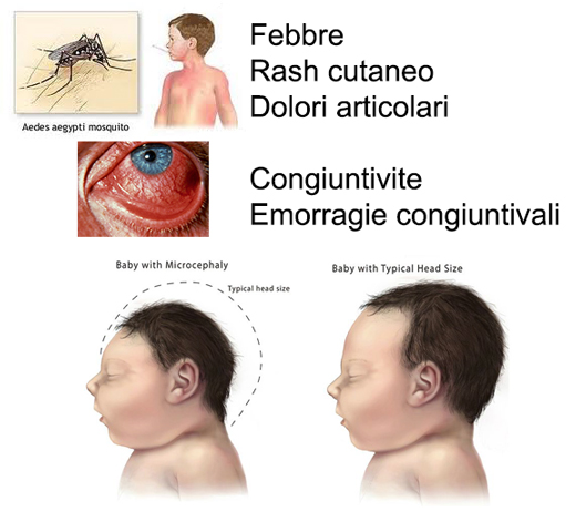 zika-sintomi